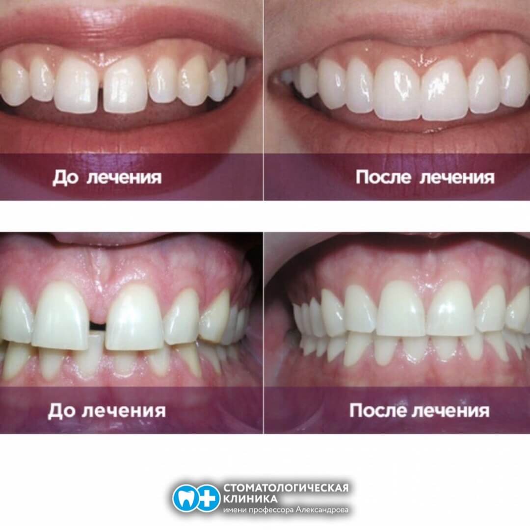 Элайнеры Томск Мало-Кирпичный стоматология центр современной стоматологии томск отзывы